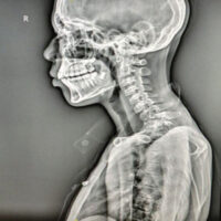 Figure 1: Pre-operative cervical spine X-ray showing T1 vertebral destruction with C7 over T2 anterolysthesis.