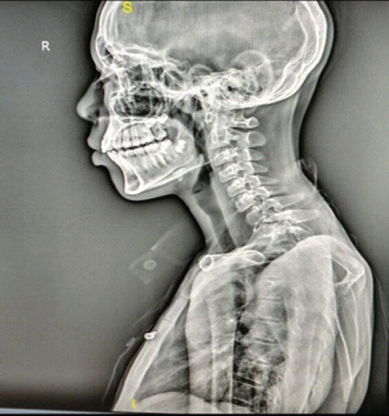 Figure 1: Pre-operative cervical spine X-ray showing T1 vertebral destruction with C7 over T2 anterolysthesis.