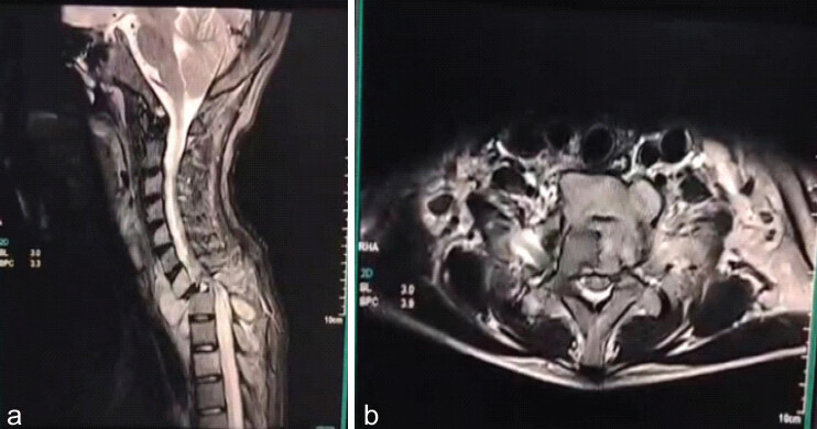 Figure 2: (a and b) Magnetic resonance imaging sagittal image showing spinal cord compression due to epidural and prevertebral abscess at the cervicodorsal junction.