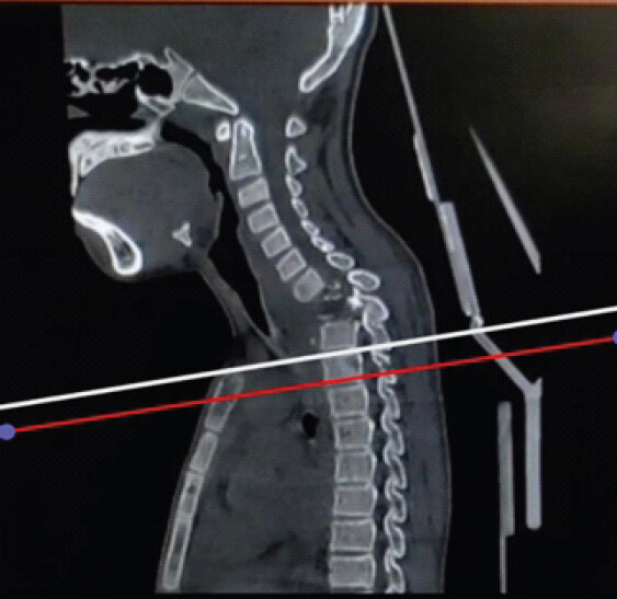 Figure 3: Pre-operative sagittal computed tomography reconstruction illustrating the surgical exposure achievable through different anterior approaches at the cervicothoracic junction. White line: Caudal limit of exposure achievable with the Karikari approach (up to the lower endplate of T2). Red line: Caudal limit of exposure achievable with the transmanubrial approach (up to the lower endplate of T3 vertebral level).