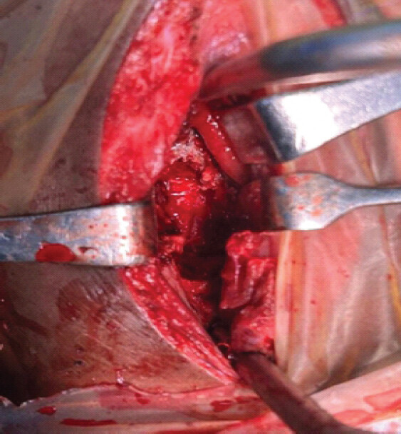 Figure 4: Intra-operative photograph demonstrating exposure of the cervicodorsal junction through the anterior transmanubrial approach following surgical access and debridement/corpectomy of the diseased vertebral segment.