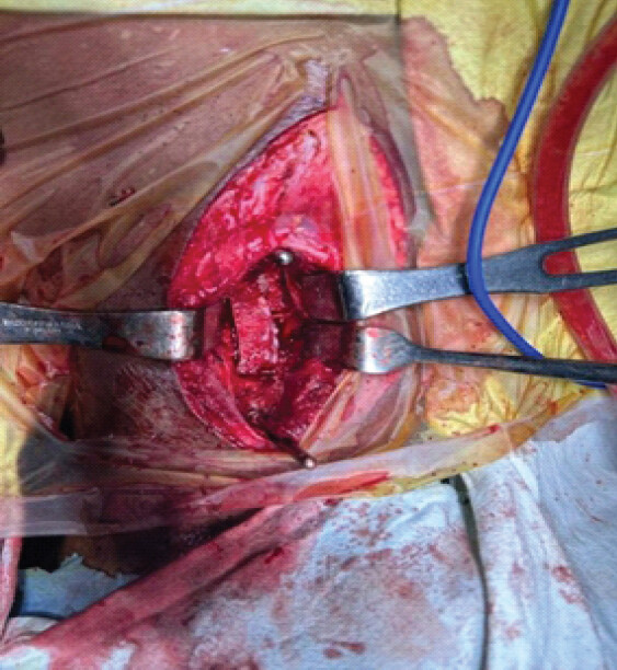 Figure 5: Intra-operative photograph showing anterior column reconstruction with placement of a structural bone graft following corpectomy.