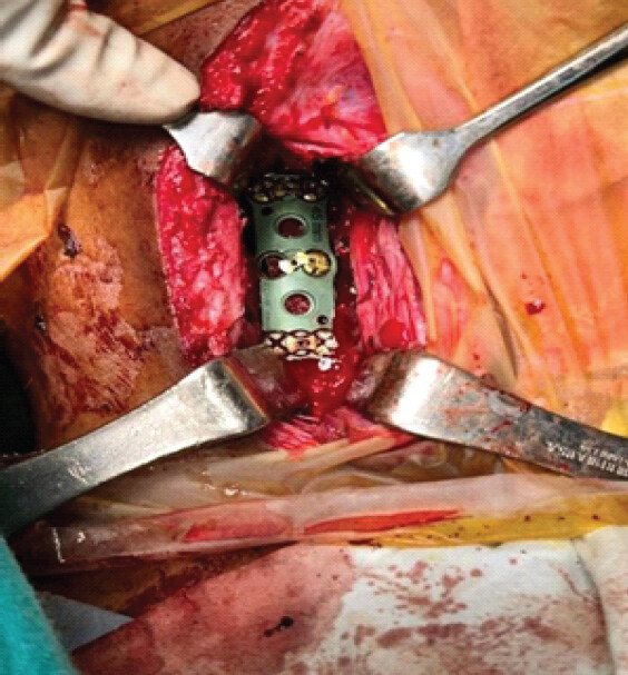 Figure 6: Intra-operative photograph demonstrating final stabilization with anterior cervical plate fixation across the cervicodorsal junction (C7–T3) after graft placement.