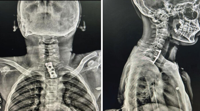 Figure 7: Post-operative anteroposterior and lateral cervical spine radiographs demonstrating anterior cervical plate fixation.