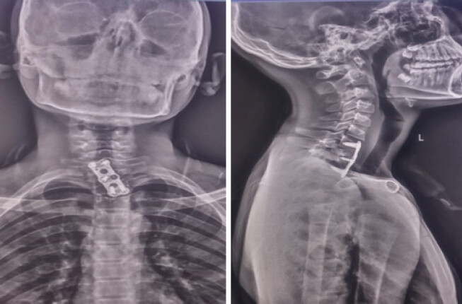 Figure 8: One-year follow-up anteroposterior and lateral radiographs of the cervical spine demonstrating maintained alignment, stable implant position, and satisfactory fusion across the cervicothoracic junction.