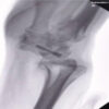 Proximal Row Carpectomy for Established Post-Traumatic Radiocarpal Arthritis Following Distal Radius Volar Rim and Scaphoid Fractures: A Case Report