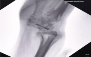 Figure 1: Pre-operative clinical photograph demonstrating wrist deformity and swelling. Pre-operative clinical photographs of the right wrist demonstrating healed surgical scars following previous treatment and persistent functional limitation secondary to post-traumatic radiocarpal arthritis.