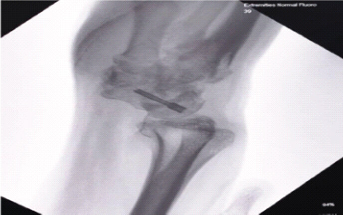 Figure 1: Pre-operative clinical photograph demonstrating wrist deformity and swelling. Pre-operative clinical photographs of the right wrist demonstrating healed surgical scars following previous treatment and persistent functional limitation secondary to post-traumatic radiocarpal arthritis.