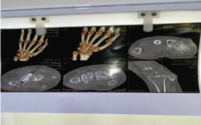 Figure 2: Pre-operative radiograph showing distal radius volar rim fracture with associated scaphoid injury. Pre-operative anteroposterior and lateral radiographs of the right wrist demonstrating a malunited distal radius volar rim (volar lunate facet) fracture with an associated scaphoid fracture, resulting in radiocarpal incongruity and early degenerative arthritic changes.