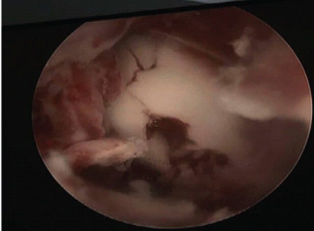 Figure 3: Arthroscopic image demonstrating radiocarpal chondral degeneration. Diagnostic wrist arthroscopy demonstrating advanced chondral degeneration of the radiocarpal joint consistent with established post-traumatic arthritis.