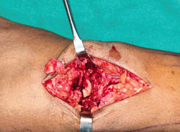 Figure 4: Intraoperative excision of proximal carpal row. Intraoperative photographs showing dorsal exposure of the wrist and sequential excision of the proximal carpal row (scaphoid, lunate, and triquetrum) during proximal row carpectomy.