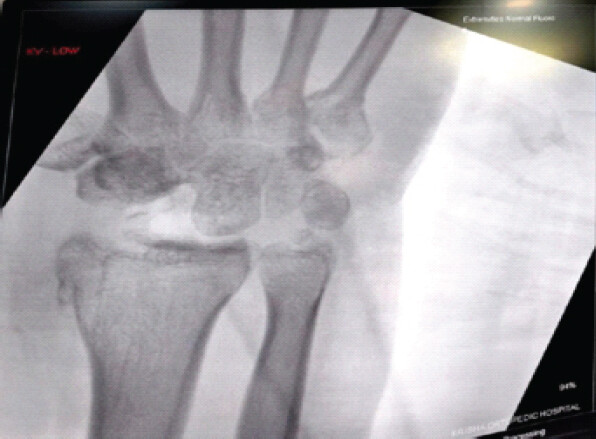 Figure 5: Post-operative radiograph following proximal row carpectomy (PRC). Immediate post-operative anteroposterior and lateral radiographs confirming successful PRC with satisfactory radiocapitate alignment and K-wire stabilization.