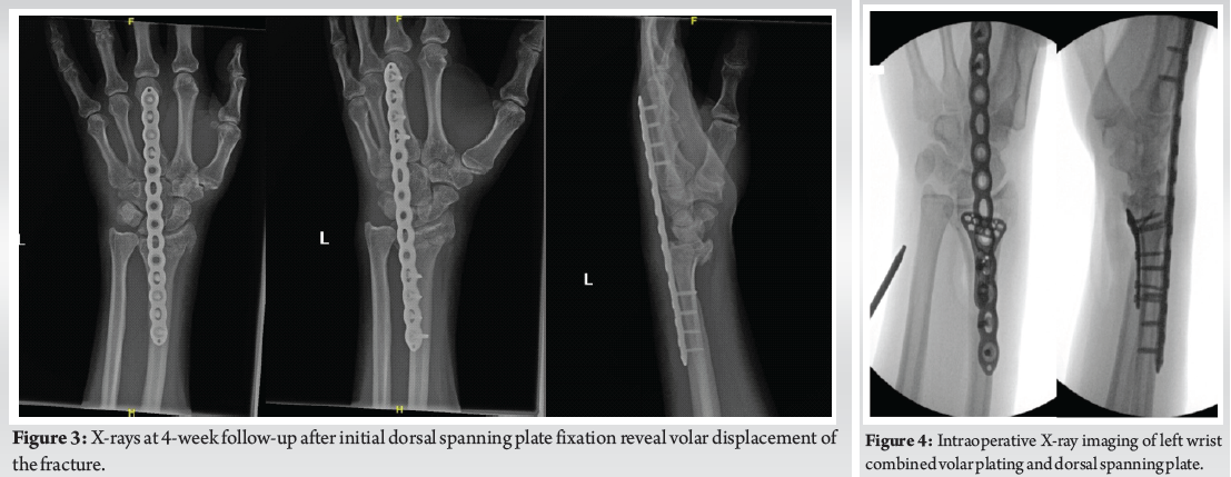 Fixation of 3-Part Intra Articular Distal Radius Fracture with Combined ...