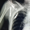 Complex Scapulothoracic Disruption Managed with Scapular Dual Column Plating and Acromion Tension Band Osteosynthesis: A Radiological and Functional Success Story