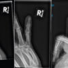 An Unusual Presentation of Right fifth Flexor Digitorum Profundus Tendon Zone 3 Rupture Following Jersey Finger Mechanism Injury