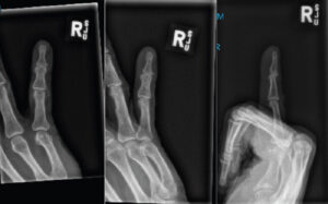 Figure 1: Right hand fifth little finger X-ray film – anteroposterior, oblique, lateral views; no fracture/lesion.