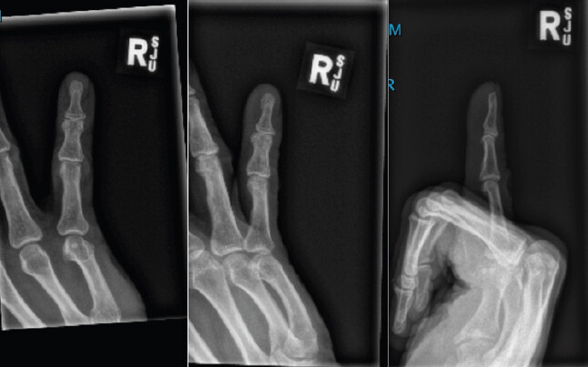 Figure 1: Right hand fifth little finger X-ray film – anteroposterior, oblique, lateral views; no fracture/lesion.
