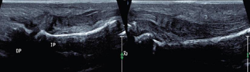 Figure 2: Ultrasound sonography investigation – right little finger flexor digitorum superficialis and flexor digitorum profundus from Flexor Zone 1- Zone 2.