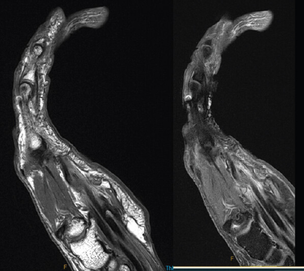 Figure 3: Right hand magnetic resonance imaging – Discontinuity of flexor digitorum profundus (FDP) tendon at the level of fifth metacarpal, but distal FDP tendon at metacarpophalangeal joint and distal interphalangeal joint is intact. Flexor digitorum superficialis is intact.
