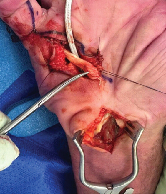 Figure 4: Intra-op photography of the distal stump at A1 pulley level. Carpal tunnel surgical wound with inflamed synovial tissue.
