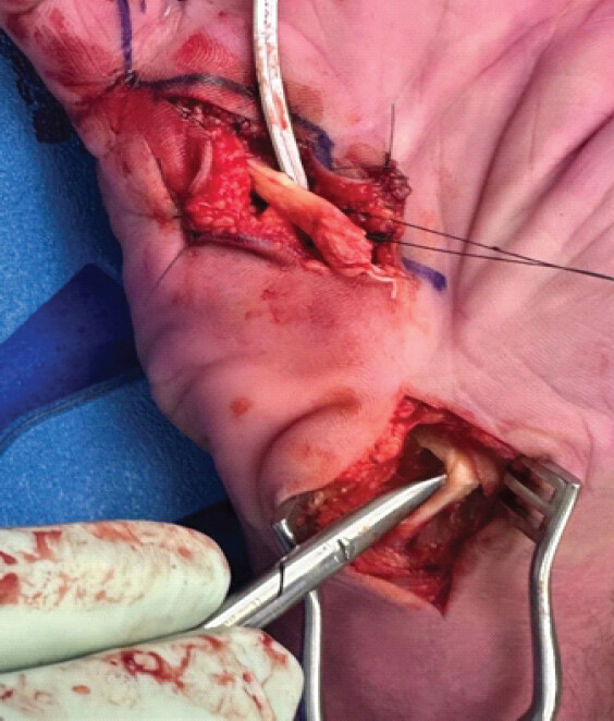 Figure 5: Intra-operative photography of the proximal stump at the carpal tunnel level.