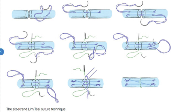 Figure 6: Lim-Tsai tendon 6-strand repair technique [10, 11].