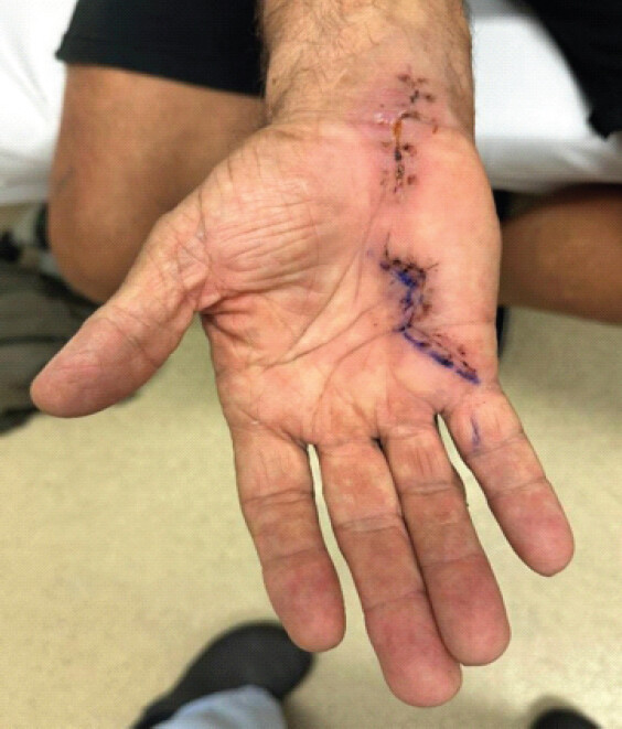 Figure 6: 2-week post-operative surgical wound outcome with normal right little finger resting attitude.