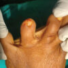 Glomus Tumor of the 4th Toe: A Case Report