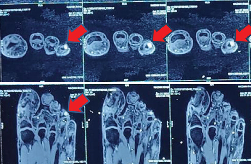Figure 3: Magnetic resonance imaging with an arrow pointing the tumor.