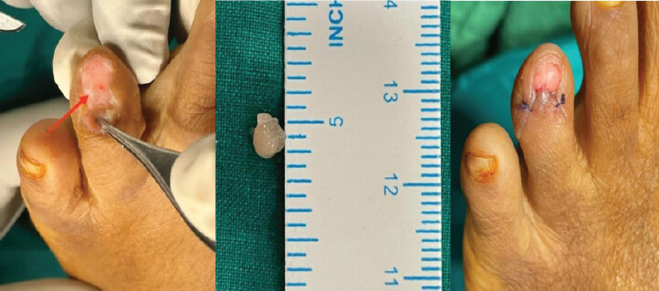 Figure 4: Excised tumor.