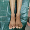 Giant Cell Tumor of the Lateral Malleolus Treated by Tumor Excision and Reconstruction using A 180° Rotated Proximal Fibular Autograft – A Rare Case Report