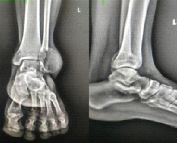 Figure 2: Pre-operative X-rays.