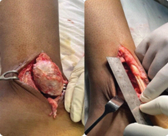 Figure 4: Resection of the tumor.
