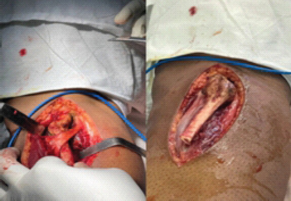 Figure 5: Harvesting proximal fibula graft.