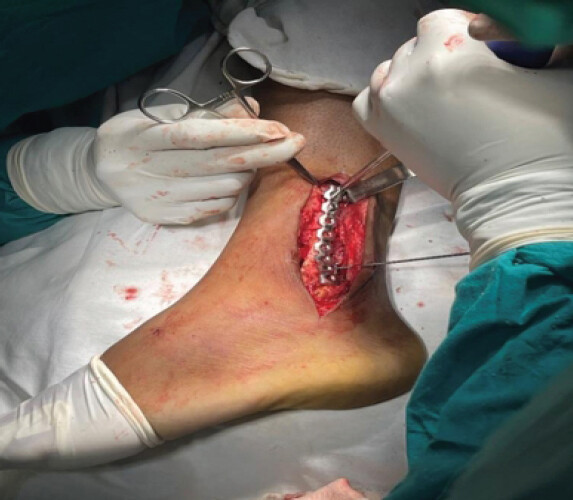 Figure 6: Reconstructing the ankle joint.