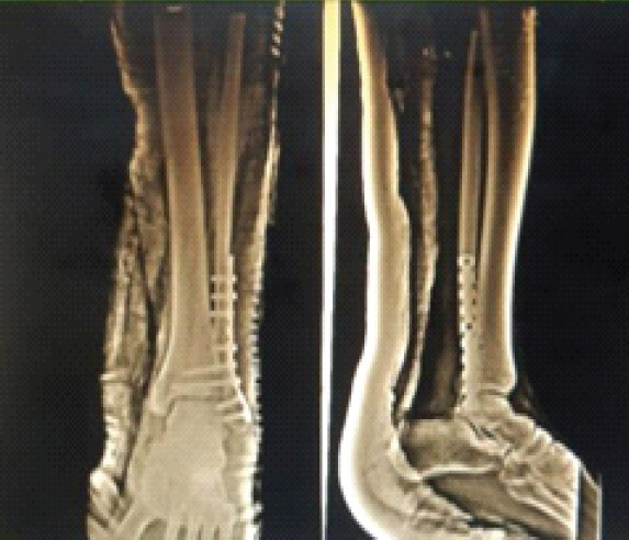 Figure 7: Immediate post-operative X-ray.