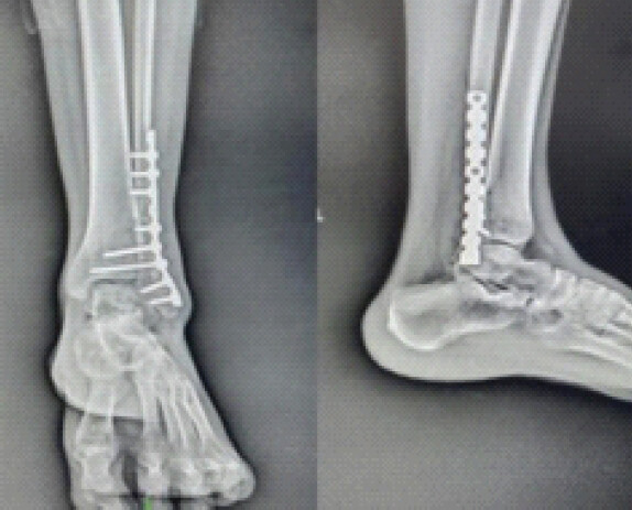 Figure 9: Follow up X-ray.