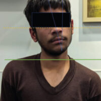 Figure 1: Clinical photograph showing right-sided torticollis and asymmetry of shoulder and ear levels.