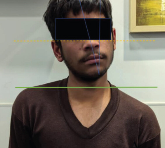 Figure 1: Clinical photograph showing right-sided torticollis and asymmetry of shoulder and ear levels.