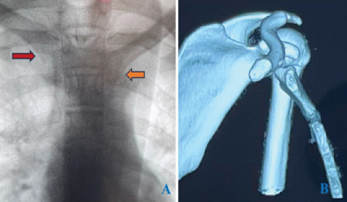 Figure 2: Imaging showing posterior dislocation of the left sternoclavicular joint. (a) Radiograph; (b) 3D computed tomography reconstruction.