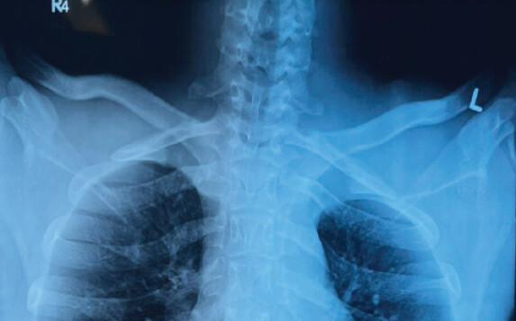Figure 3: Post-reduction serendipity radiograph showing restored and symmetrical sternoclavicular joint alignment.