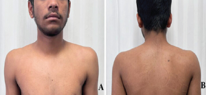 Figure 4: Two-year follow-up photographs showing symmetrical shoulders and complete resolution of torticollis.