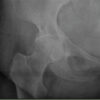 Incidentally Detected Osseous Hemangioma of the Femoral Head: Conservative Management of a Rare Case with Review of the Literature