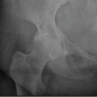 Figure 1: Plain radiograph of the right hip in anteroposterior view showing a lucent lesion in the inferior quadrant of the femoral head with a sclerotic margin.