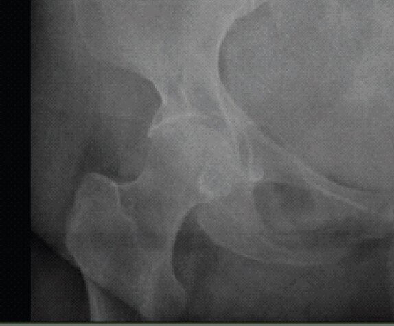 Figure 1: Plain radiograph of the right hip in anteroposterior view showing a lucent lesion in the inferior quadrant of the femoral head with a sclerotic margin.