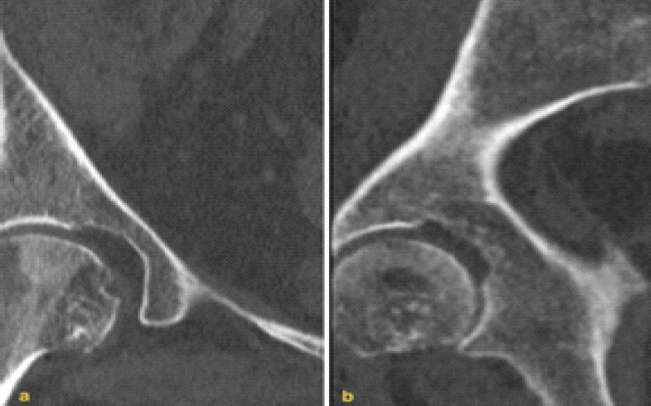 Figure 2: Coronal computed tomography images of the right hip in the (a) coronal and (b) sagittal planes demonstrating a medullary osseous hemangiomas occupying the medial aspect of the femoral head with extension into the inferior quadrant. The lesion is parallel to the long axis of the femur, expansile, lytic, and has a regular margin with a narrow.