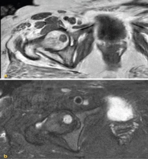 Figure 3: Magnetic resonance imaging images of the right hip in the axial plane in (a) T1-weighted turbo spin-echo image demonstrating hypointense signal with spiculated bony trabeculae which are characterized by elevated signals within the dark cortex and in (b) T2-weighted spectral attenuated inversion recovery image sequences demonstrating marked hyperintensity correlating to the fluid content within the lesion.