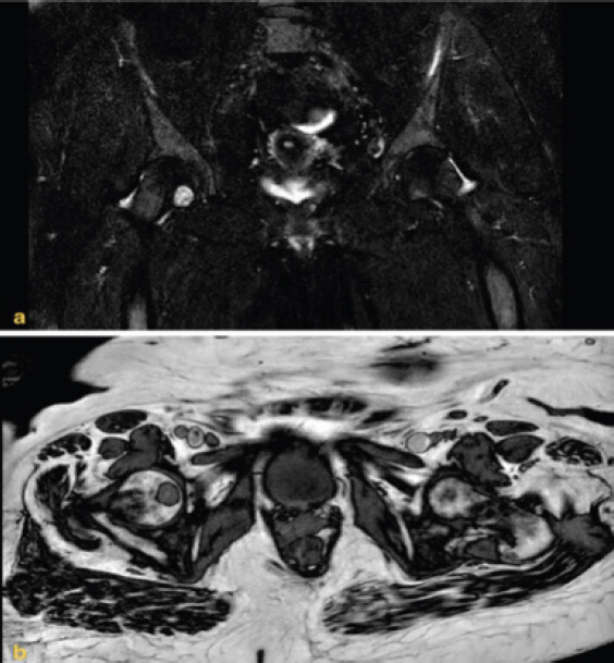 Figure 4: Coronal magnetic resonance imaging of the right hip demonstrating (a) low signal intensity on T1-weighted imaging and (b) high signal intensity on T2-weighted imaging, consistent with the characteristic appearance of an intraosseous hemangioma.