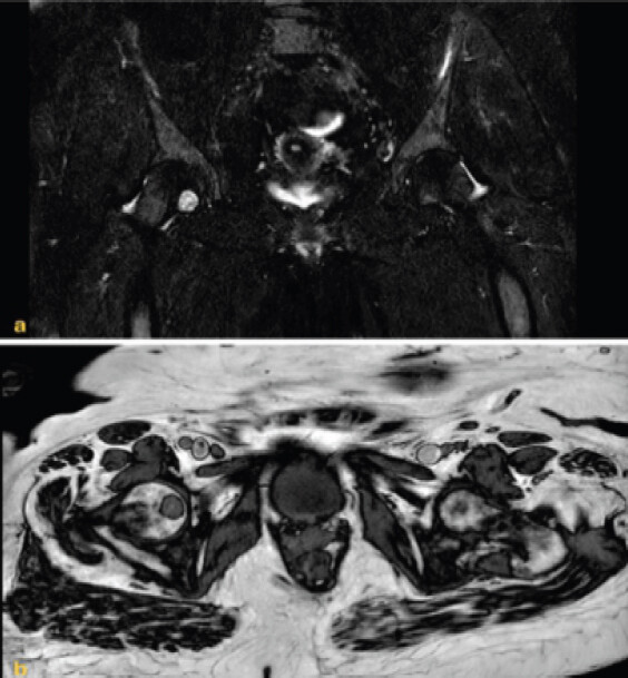 Figure 5: Six-month follow-up coronal magnetic resonance imaging in the (a) coronal and (b) (axial) planes demonstrating stable appearance of the infra-foveal intraosseous hemangioma without interval progression or aggressive imaging features.