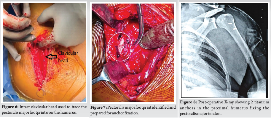 A Wrestler’s Nightmare: Pectoralis Major Tendon Tear and its Repair-A ...